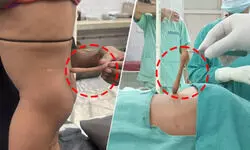 लखनऊ: बलरामपुर अस्पताल में डेढ़ साल के बच्चे की पीठ से 14 सेमी लंबी जन्मजात पूंछ सफलतापूर्वक हटाई गई