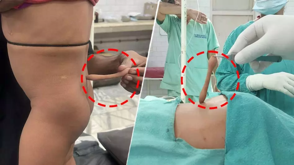 लखनऊ: बलरामपुर अस्पताल में डेढ़ साल के बच्चे की पीठ से 14 सेमी लंबी जन्मजात पूंछ सफलतापूर्वक हटाई गई