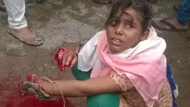 लखीमपुर की बेटी का कटा हाथ KGMC के डाक्टरों ने १० घंटे की सफल सर्जरी से जोड़ दिया