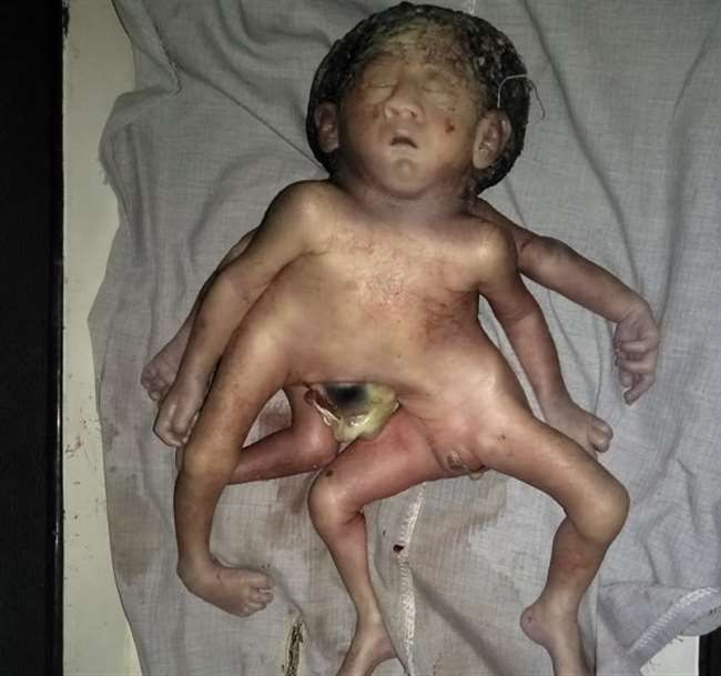 चार हाथ, चार पैर और दो लिंग वाले बच्चे का जन्म, देखने वालों का लगा रहा तांता