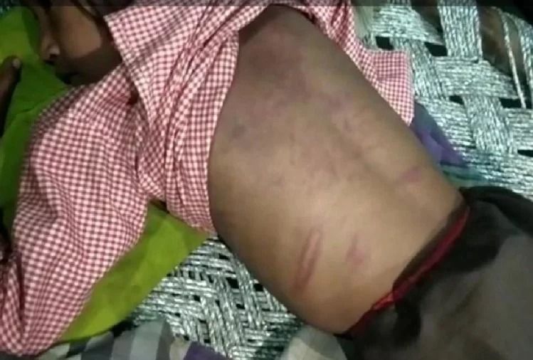 होम वर्क पूरा न होने पर मासूम छात्रा को बेरहमी से पीटा