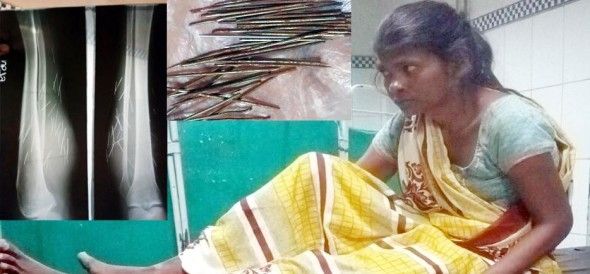 साइंस के लिए अजूबा बनी ये लड़की, पैरों से निकल रहीं लोहे की कीलें साइंस के लिए अजूबा बनी ये लड़की, पैरों से निकल रहीं लोहे की कीलें