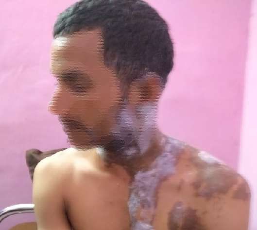 एकतरफा प्यार में लड़की ने फेंका तेजाब।