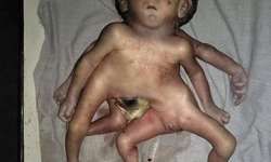 चार हाथ, चार पैर और दो लिंग वाले बच्चे का जन्म, देखने वालों का लगा रहा तांता