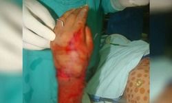 11 घंटे ऑपरेशन में जुड़ा था पंजा, आज डॉ. बोले- अब इसे काटना होगा 11 घंटे ऑपरेशन में जुड़ा था पंजा, आज डॉ. बोले- अब इसे काटना होगा